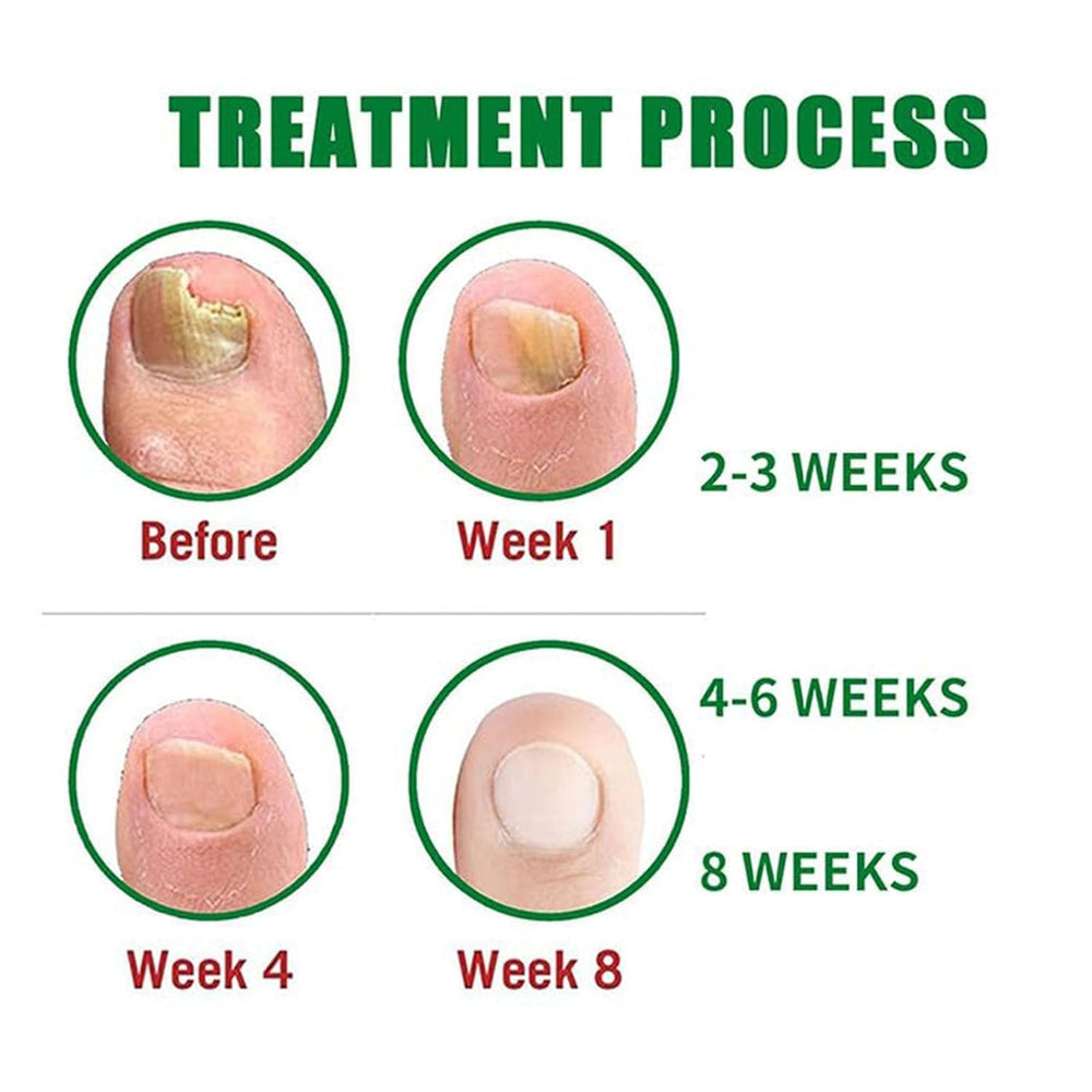 Beuifvo Nail Fungus Treatment Gel 20ml tube ready for travel.