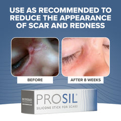 Hands holding the tube demonstrates easy, controlled application of ProSIL Scar Stick.