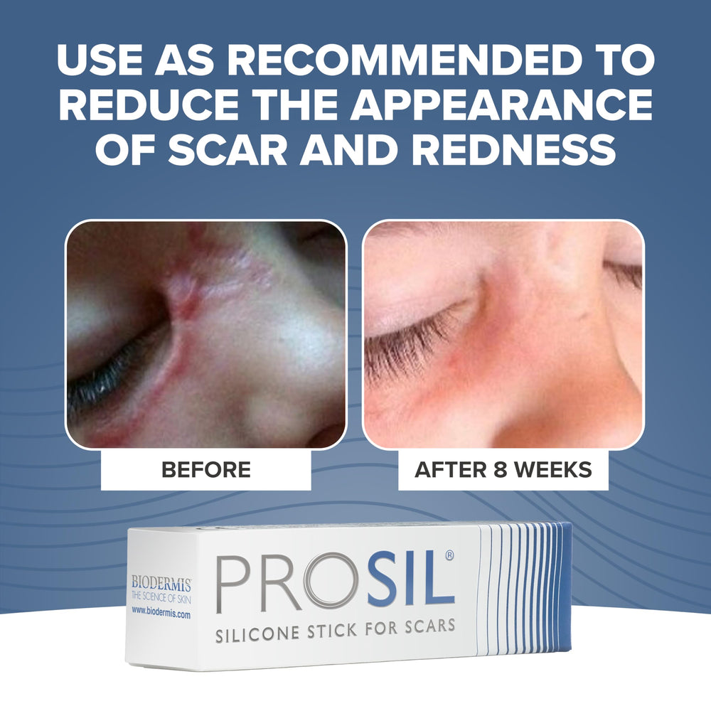 BIODERMIS PROSIL scar stick applied to skin for gentle scar care.