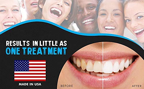 Before and after whitening comparison using Bright White Smiles kit