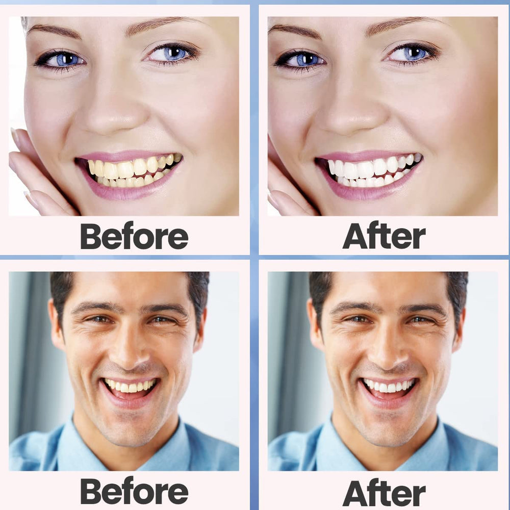 Bright, whiter smile after whitening treatment