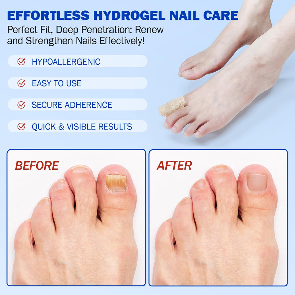 Cacukn toenail patch application on nail demonstrates secure overnight adhesion for effective treatment.