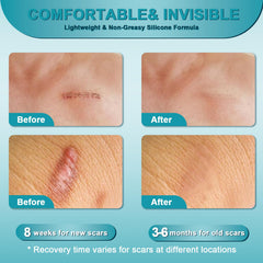 ClearPiny Scar Cream on skin creating breathable, protective barrier.