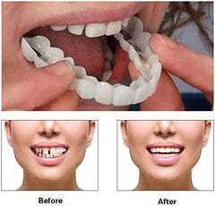 Confident natural smile with white aligners