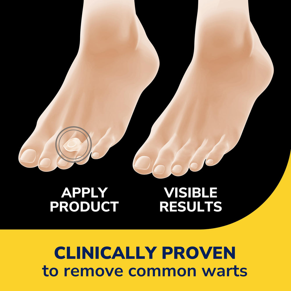 Dr. Scholl's Clear Away bandages being applied for simple wart care