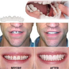 Easy-fit at-home setup for smile aligners