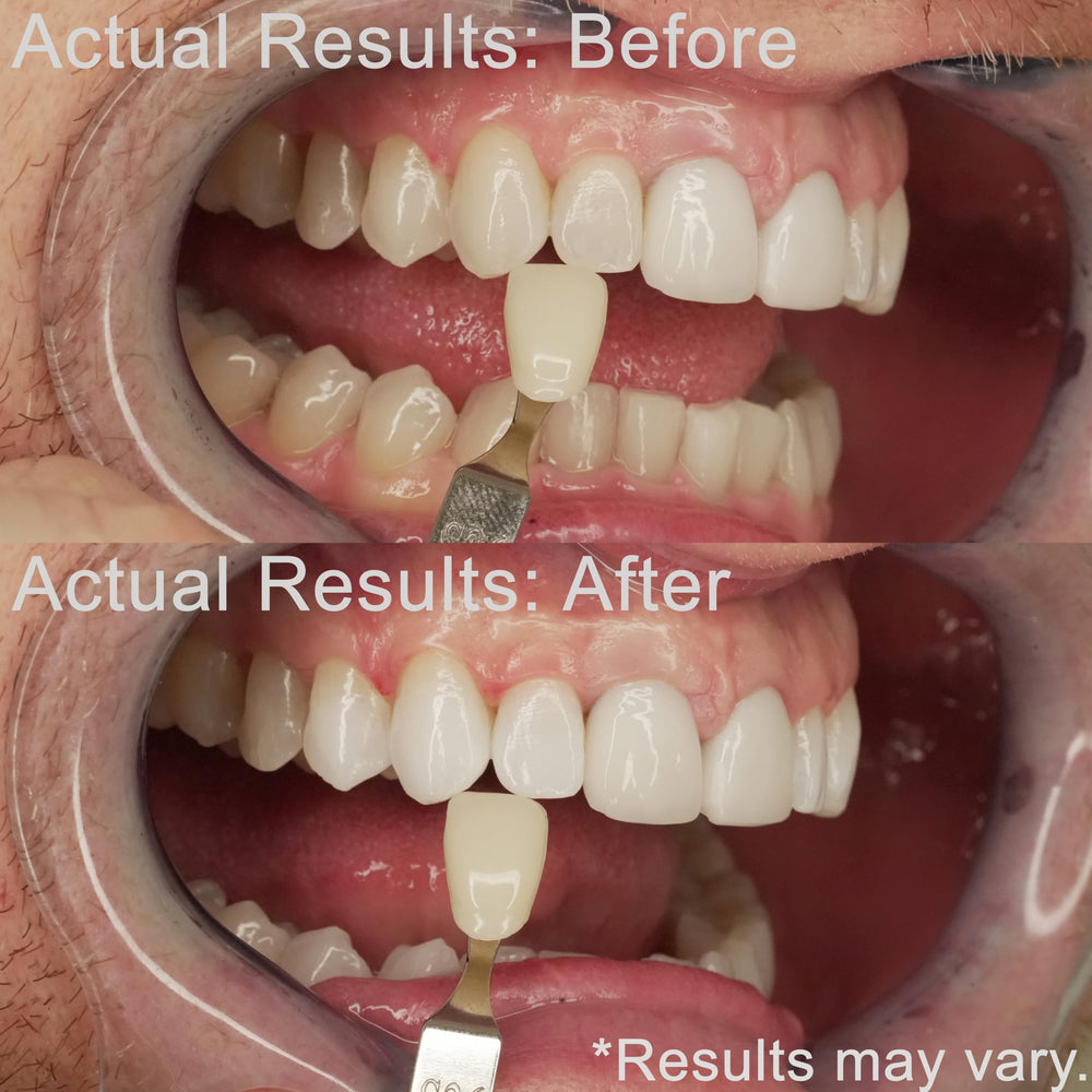 EZZI whitening gel syringes and tubes