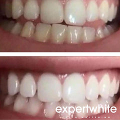 Tray-ready whitening gel bottles for at-home dental whitening.