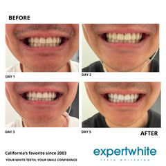 Before and after teeth whitening results