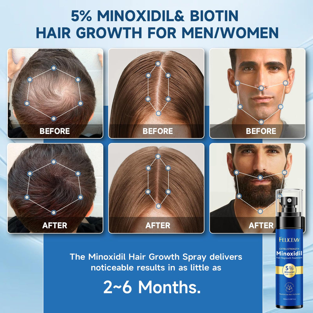 Felicemy Minoxidil scalp close-up showing follicle activation potential
