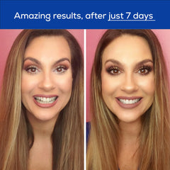Travel-friendly whitening kit with lip care and vials