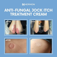 Hermon Jock Itch Cream lid-open shot for easy application
