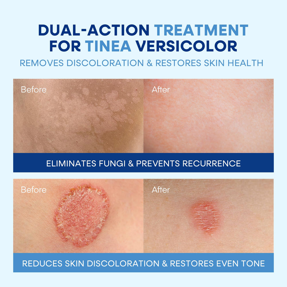 Hermon Tinea Kit Complete showcases a multi-step approach for skin health.