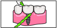 IDontix Brace X-Floss Green product image 5 – threader insertion demonstration