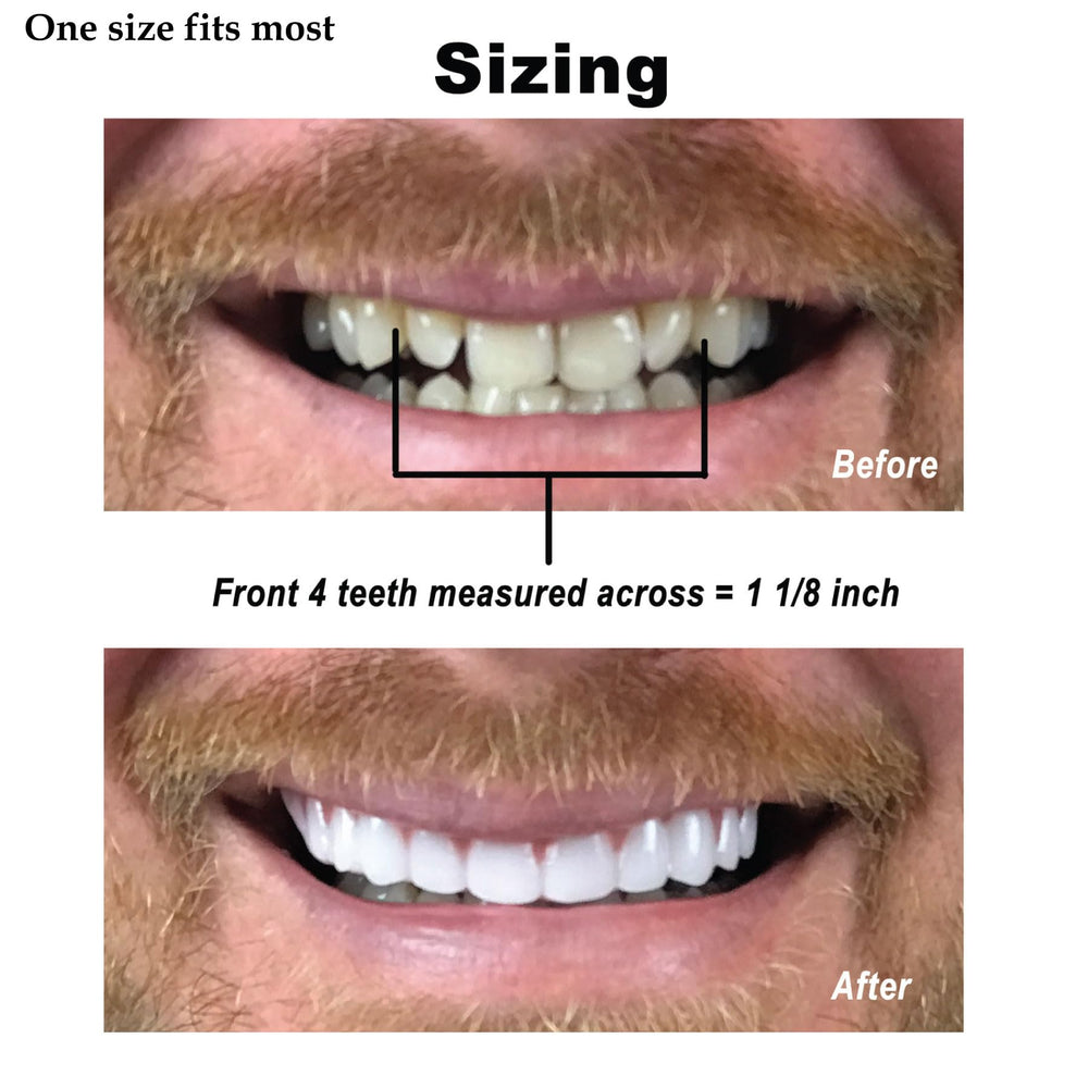 All veneers displayed together for sizing and fit reference