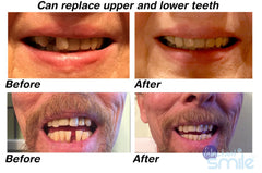 Patented design ensuring a realistic look and feel for temporary tooth repair