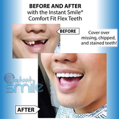 Pro Series Temporary Tooth Replacement Kit with 40 replacement teeth