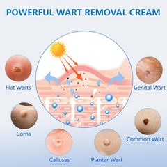 KIbabyDI freeze-off technology illustration highlights root-level wart targeting and removal potential.