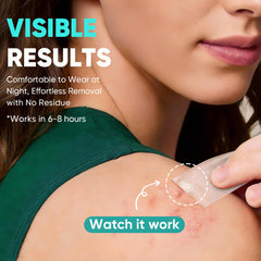 Kindshine hydrocolloid patches close-up illustrating fluid drawing action.