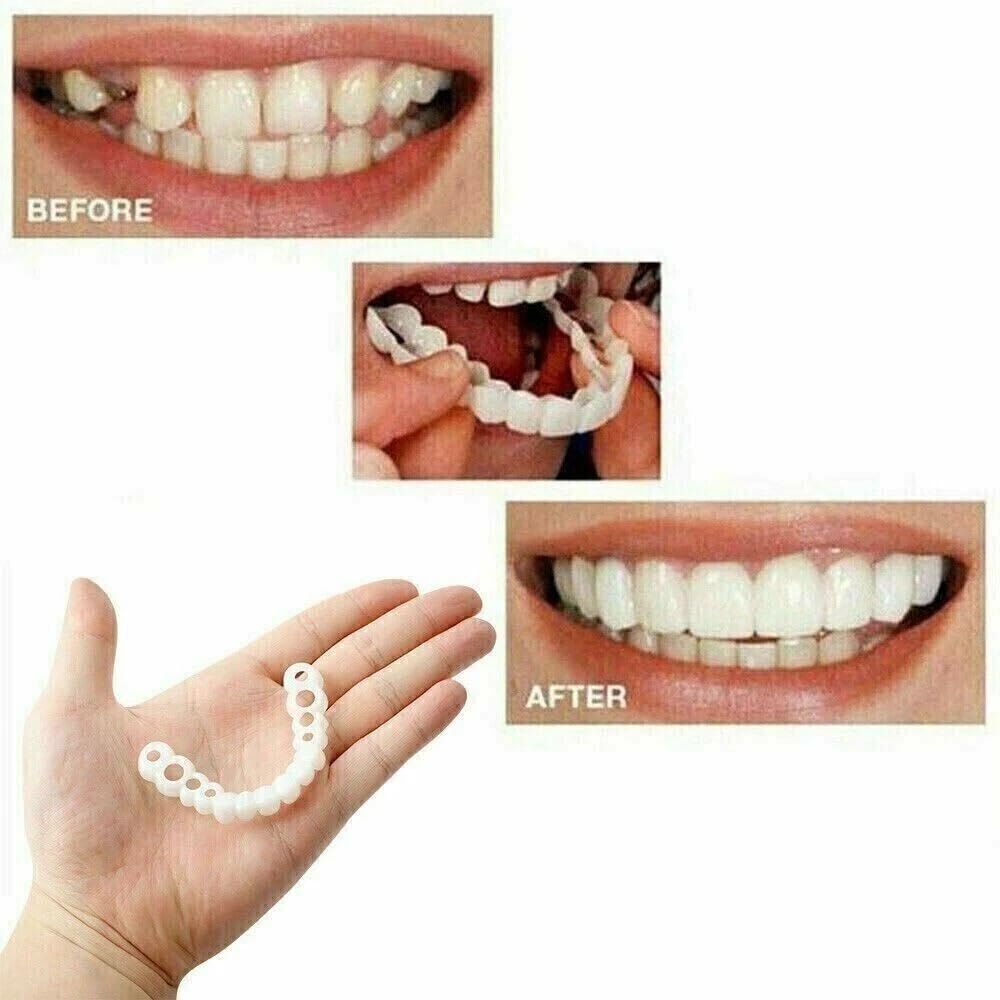 Contents of the at-home temporary smile kit
