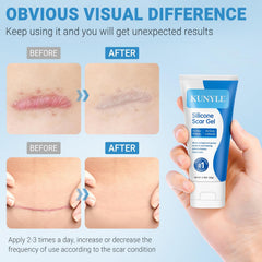 Applying Kunyle scar gel on scar area for softening