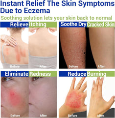 LMNOOP eczema cream application on hand demonstrates easy spot relief