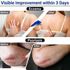 LMNOOP Eczema Cream menthol close-up suggests cooling relief for itch.