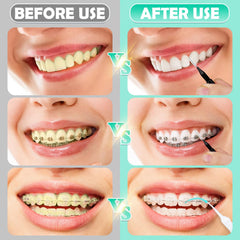Cleaning around braces using MAPVOLUT interdental brush