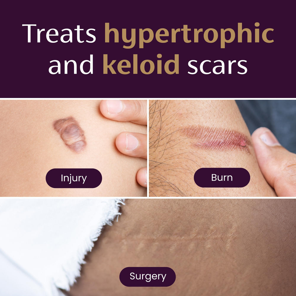 Mederma is a trusted brand by doctors and pharmacists for scar care.