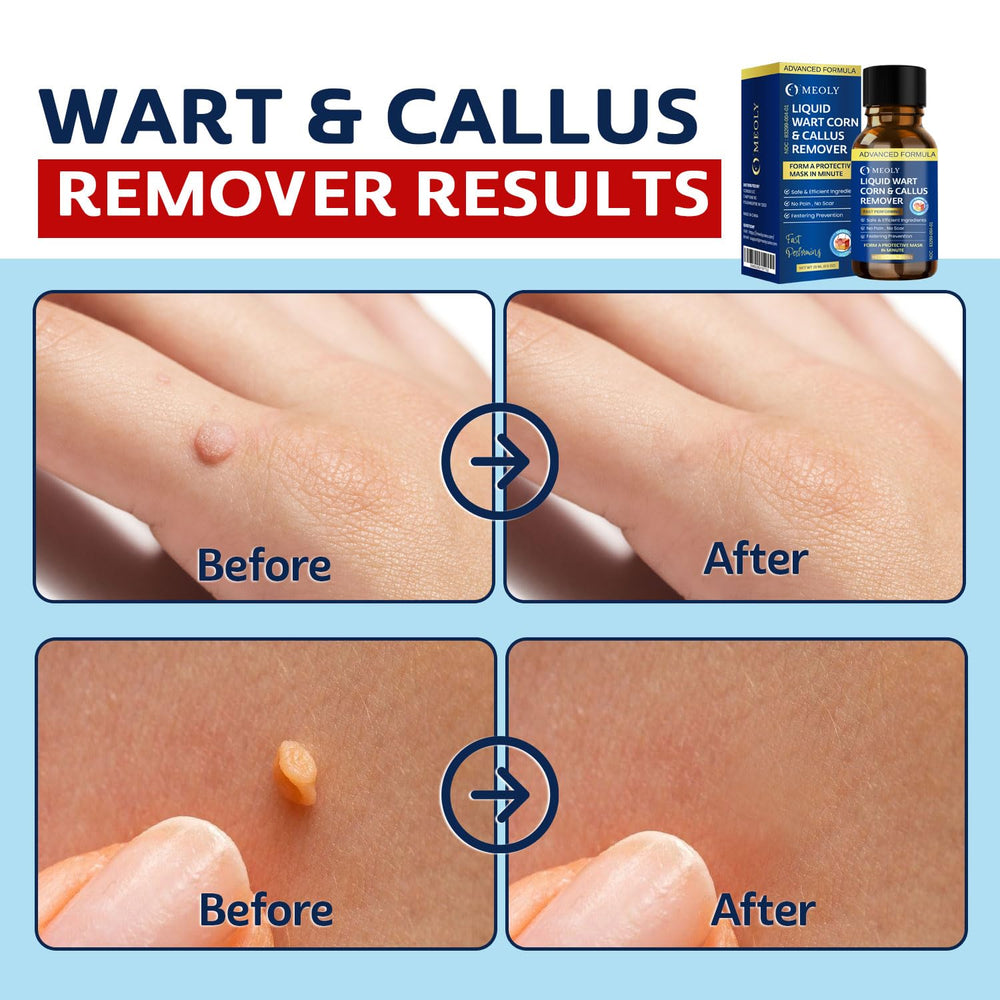 MEOLY wart remover mask formation demonstrates surface coverage