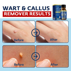 MEOLY wart remover mask formation demonstrates surface coverage