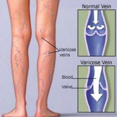 Cooling and revitalizing effect of Mivolis Vein Gel on legs