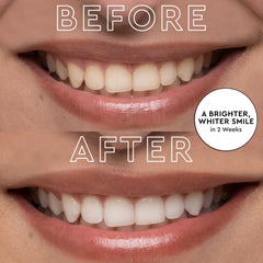 Wireless LED whitening device in use