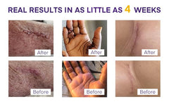 MURASAKI BEAUTY travel-size scar gel tube ready for travel.