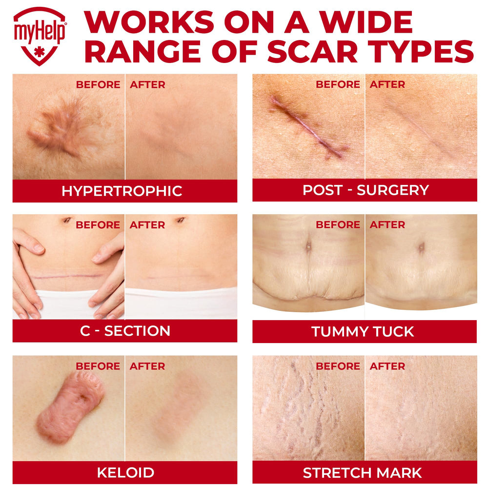 MYHELP flexible silicone strips fit facial and body scars effectively