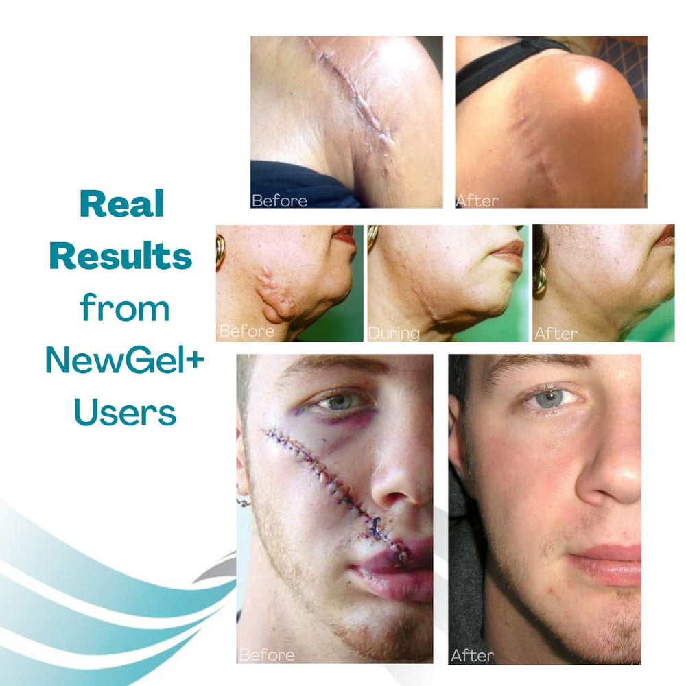 Beige sheet worn under clothing for daily scar care with discretion