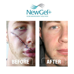 Scar area application with MyNewGel Plus shows comfortable, discreet gel use.