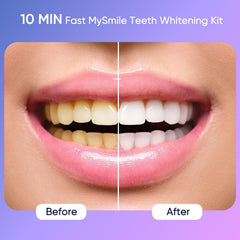 Gel bottle showing 35% carbamide peroxide in MySmile kit