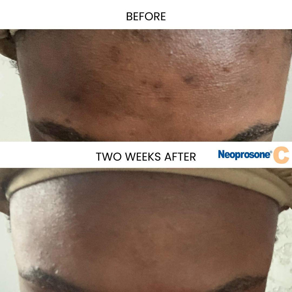 Neoprosone Vitamin C Serum being applied to the cheek for smooth absorption