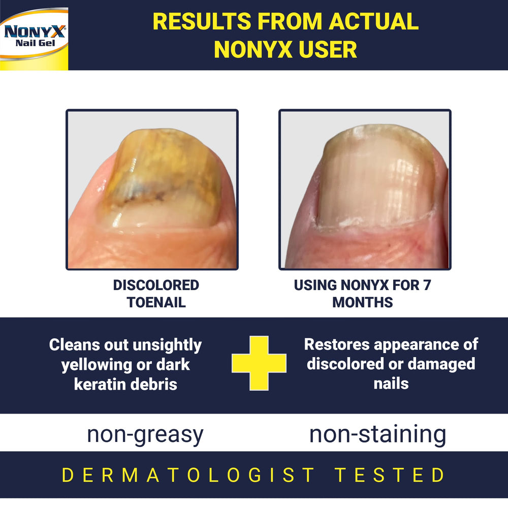 NONYX Fungal Nail Clarifying Gel application shot shows easy daily use for nail appearance.
