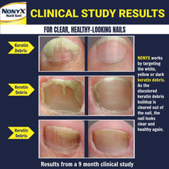 NONYX Fungal Nail Clarifying Gel closeup nails highlights improved coloration and smooth texture.