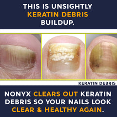 NONYX Fungal Nail Clarifying Gel six-month supply packaging emphasizes value.