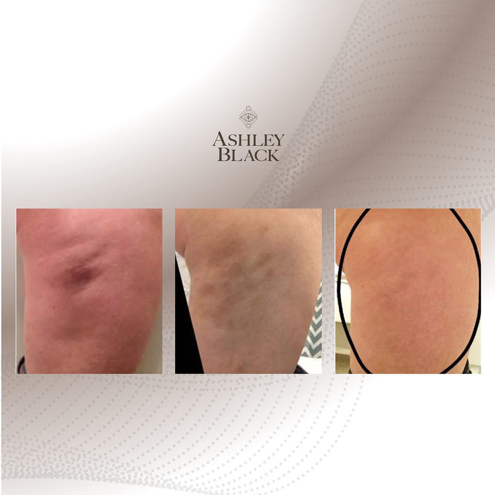 Nugget used on back or shoulder areas for deep tissue massage