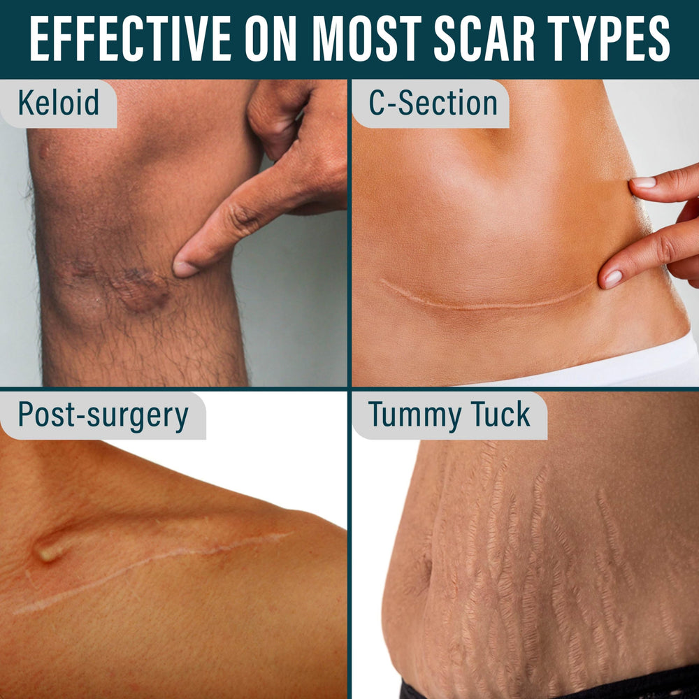 NUVADERMIS soft breathable scar tape conforms to skin contours
