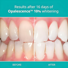Carbamide peroxide whitening gel-filled syringes for Opalescence 10% whitening