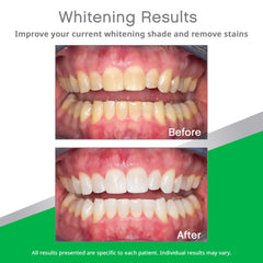 Mint flavor Opalescence Go trays by Ultradent