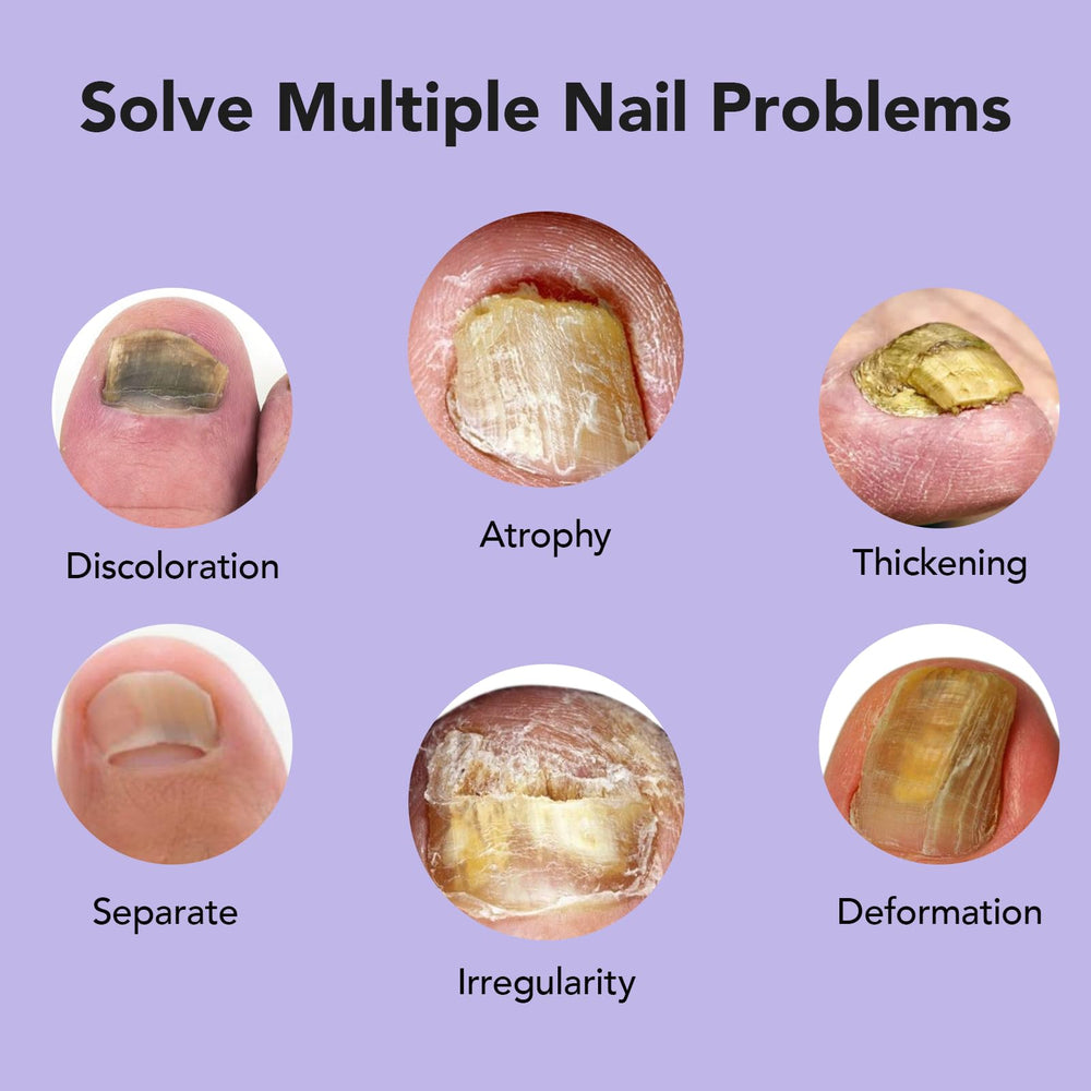 ourui one ingrown toenail treatment feature highlights targeted relief in problem areas