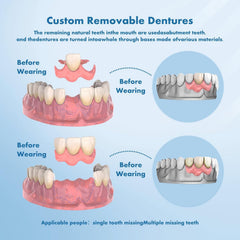 Comfortable, molded-fit partial denture shown during eating