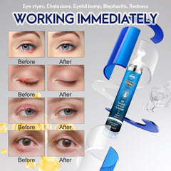 PENNTR Stye Eye Treatment packaging highlights portable, on-the-go eyelid care.