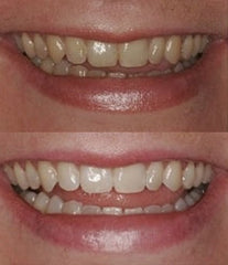 Close-up of a 3ml ProDental whitening gel syringe
